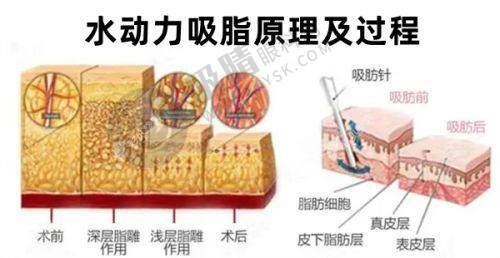 武汉硚口卓美医疗美容门诊部：KISS仿生双眼皮修复自然无痕，王海平医生亲诊预约中