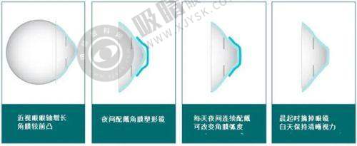2025杭州白内障手术免费政策总结呼吁