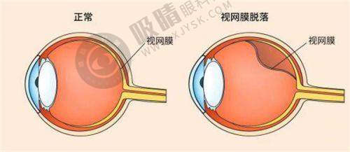 四、如何选择广州番禺爱尔眼科医院？