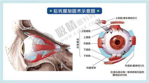 泸州唯美视眼科门诊全飞秒手术价格多少？德国蔡司设备+个性化定制方案，术后效果反馈好