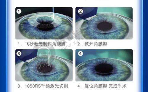 合肥东南眼科医院全飞秒激光手术价格多少？德国蔡司设备+老牌医师团队，收费12769元起