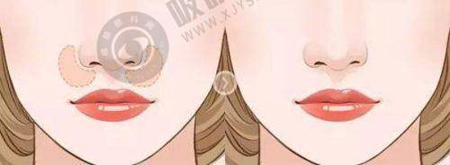 光子嫩肤实例