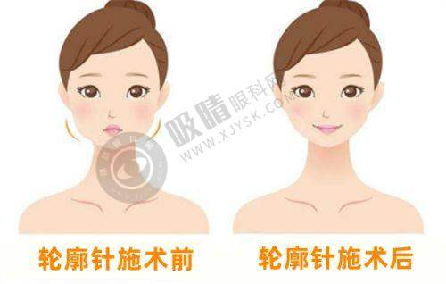 画缇骨胶原能维持多久？揭秘1-2年塑形秘诀+安全注射指南