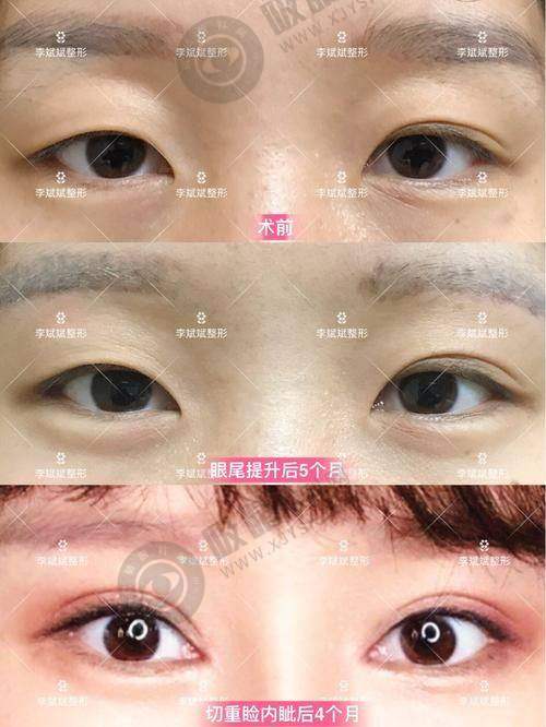 恩施美年华整形医院双眼皮修复：精细与个性的理想结合