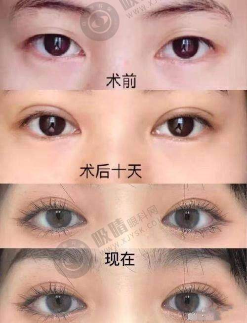 恩施美年华整形医院双眼皮修复口碑如何？精细手术+个性化设计，术后效果自然持久，顾客都说好