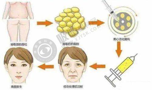 大陆市场：乔雅登美神针Harmonyca审批进程与未来展望