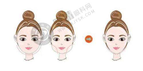 湛江韩美整形靠谱吗？揭秘鼻整形+丰胸手术真实口碑与价格