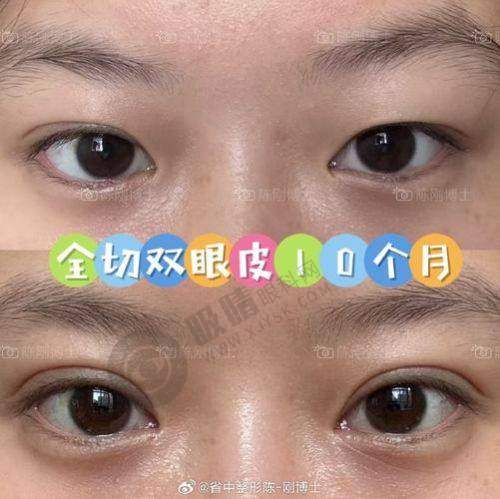 杭州美莱孟晨曦医生靠谱吗？揭秘日式晨曦眼整形技术+自然美眼效果