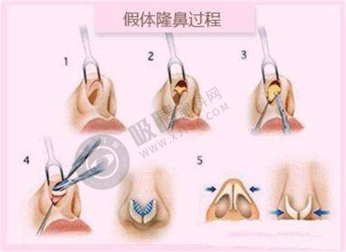 义乌欧莱美整形医院做双眼皮手术怎么样？周叶医生精细化缝合技术，打造自然开扇形效果