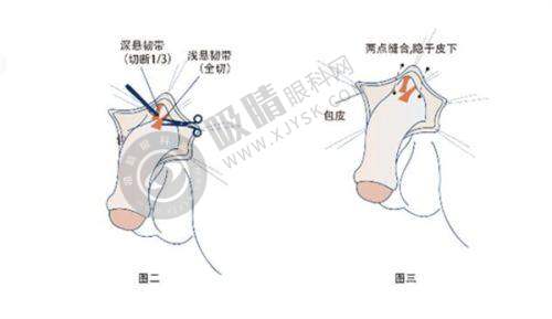 长沙韩臻医美医疗美容医院颧骨内推效果如何？邹跃平医生个性化设计，术后自然不显假