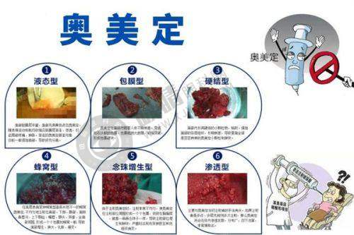 合肥保妥适除皱2280元起？揭秘维多利亚整形医院6-8个月自然效果！