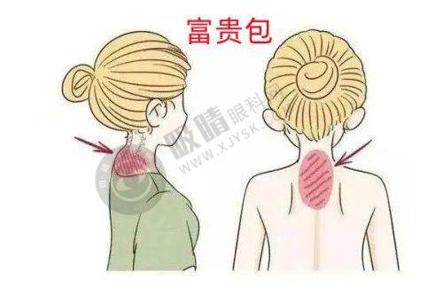 成都耳朵畸形再造真人实例分享