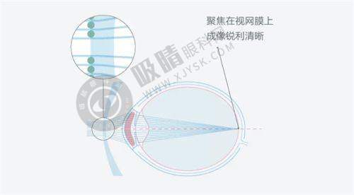 近视眼手术价格