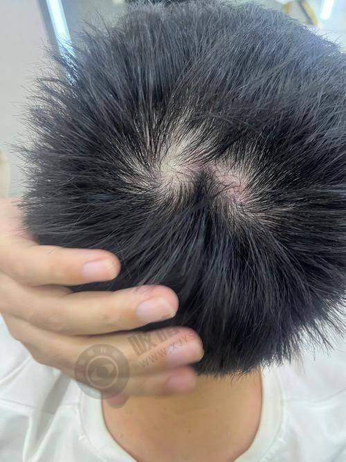 西安科美妍植发中 心特色项目及技术优势