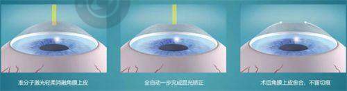 郑州大学第一附属医院眼科中 心的白内障手术有何优势？