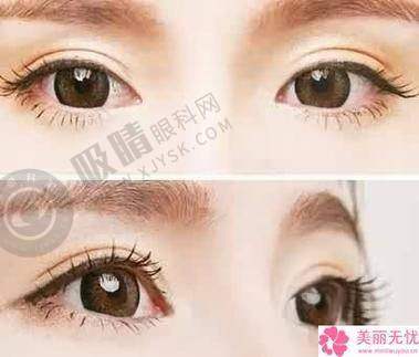 南京双眼皮医院哪家靠谱？前十口碑机构+价格表全解析