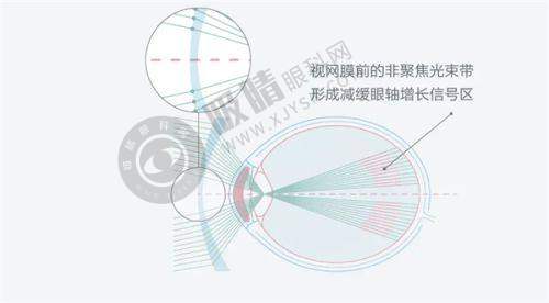 郑州大学第五附属医院眼科价格全公开：全飞秒18900元起，ICL晶体植入24500元起