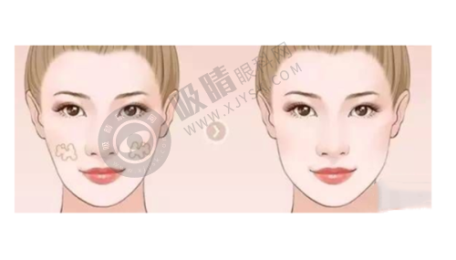 云南大学附属医院眼科价格全公开：全飞秒SMILE手术15000元起，ICL晶体植入低至20000元**