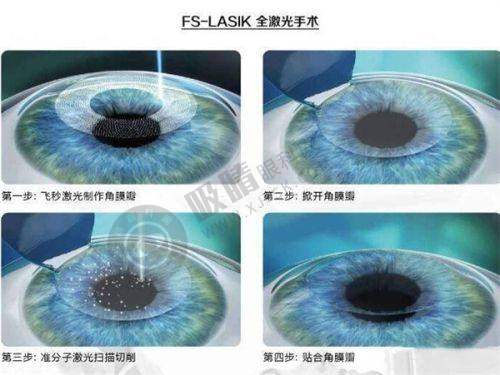 三、南阳尖峰眼科医院有哪些技术或设备优势？