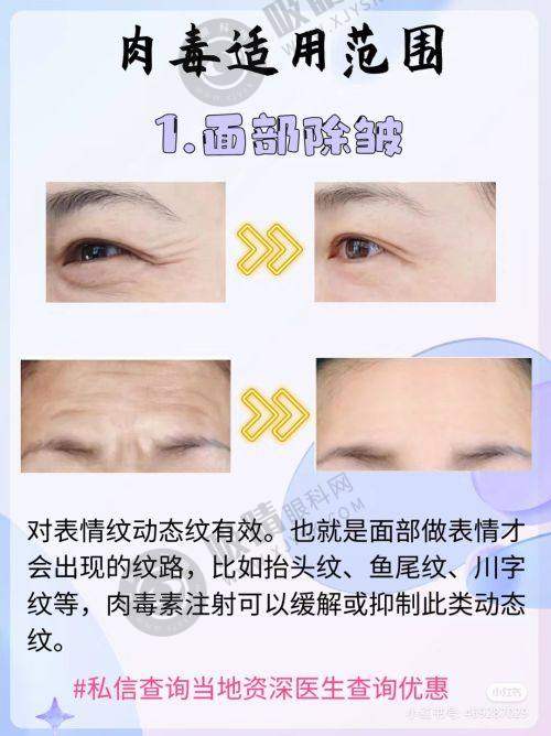 武汉艺星祛眼袋效果如何？内切去眼袋3980元起，一周恢复年轻态！