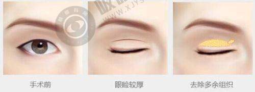 重点介绍郑州面部脂肪填充做的好的医生