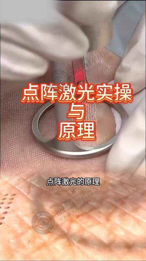 超声炮除皱全程感受分享：见证面部蜕变