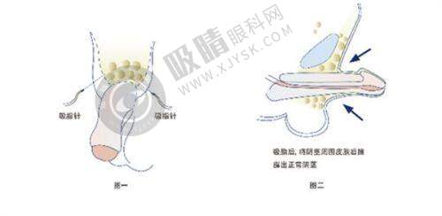 选择郑州东雅医疗美容诊所尹氏鼻综合术的理由