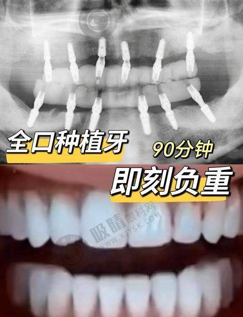 植牙额外费用需知晓