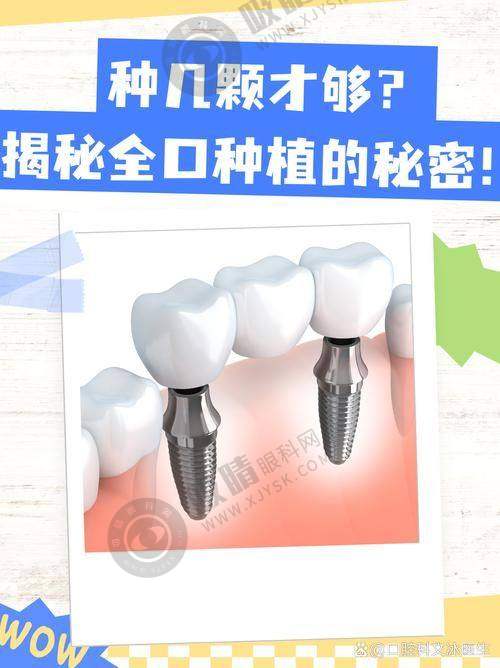 植牙价格受多因素影响