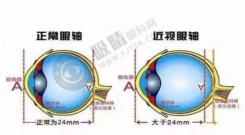 长治眼科哪家强？人民医院全飞秒+ICL手术，专业团队守护清晰视界！