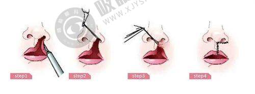 长沙辰姿医疗美容诊所怎么样？专业团队+先进设备，面部整形/隆胸口碑好