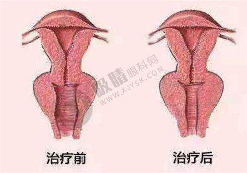 双眼皮整形项目