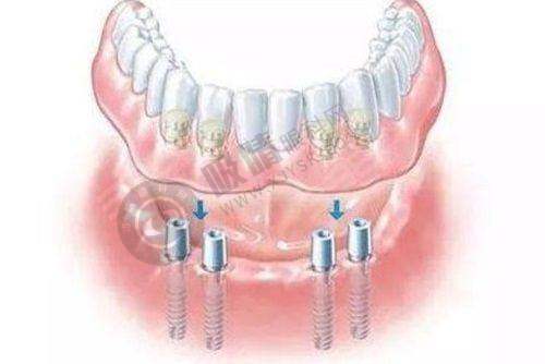 衢州贝加尔口腔诊所可靠吗?特色的瑞士ITI种植和瓷贴面修复
