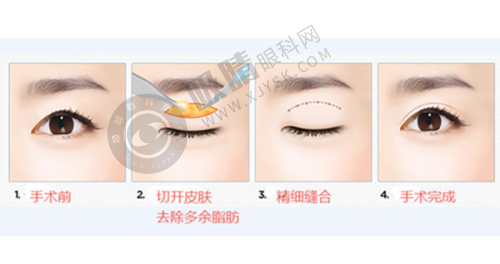 长沙伊百丽梅溪医疗美容门诊部怎么样?韩国技术+面部年轻化整形效果真实案例分享