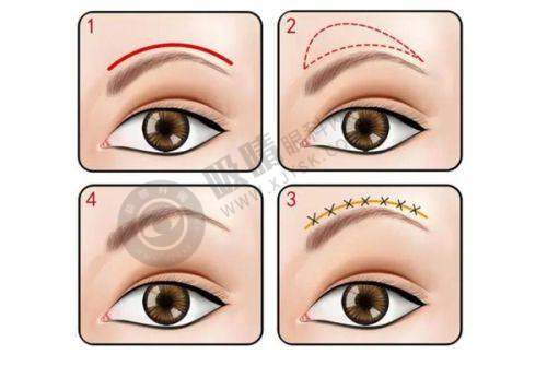 长沙星荟丽格医疗美容门诊部怎么样?——特色医美项目之黄金微针美肤