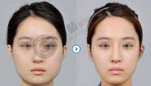 揭阳隆胸哪个医院好?聚焦揭阳华美医疗美容隆胸优势
