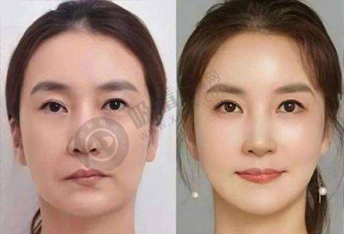 深圳最好的整形美容医院排名公开！深圳美莱医疗美容医院正规，内窥镜隆胸技术领先，口碑爆棚