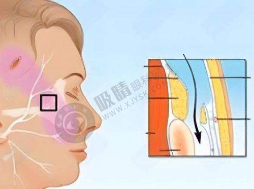 刘彦军医生做鼻子靠谱吗？鼻综合+修复案例大公开，26730元起重塑美鼻！