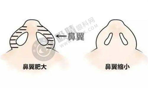 淄博壹美整形去眼袋价格大公开：其他热门项目价格