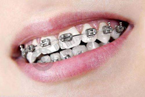 北京中诺口腔种植牙多少钱?30分钟立得用技术+亲民价格享好牙