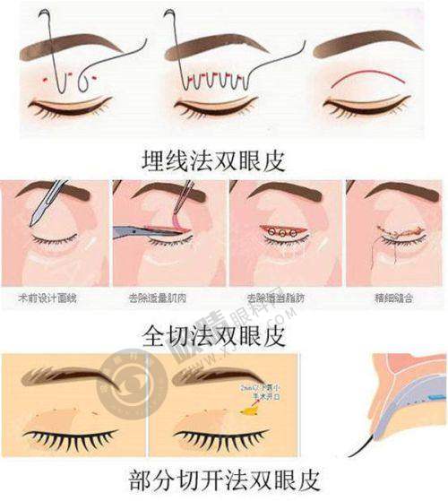 南京曹海峰：开启鼻子整形新境界之总结