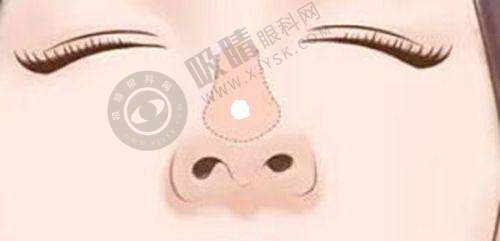 刘彦军做鼻子范例集结