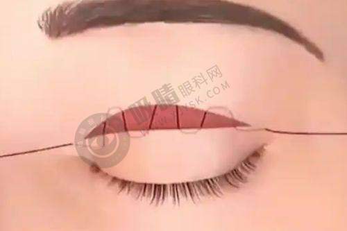 南京双眼皮医生谁做得好?陈小剑自然风、马秀云抗衰眼、李成成漫画眼各有所长