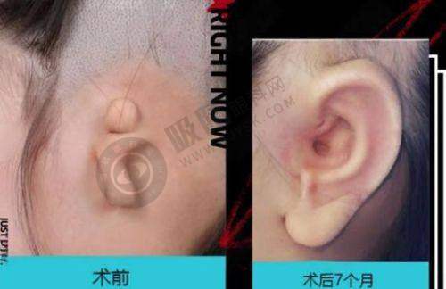 李喆筋膜提升顾客病例