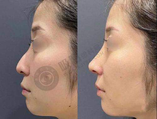 湖南省人民医院整形科——长沙隆胸假体胸型调整的成熟之选