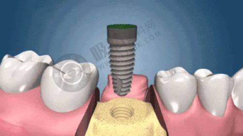 深圳新安麦芽口腔——宝安连锁种牙性价比之选