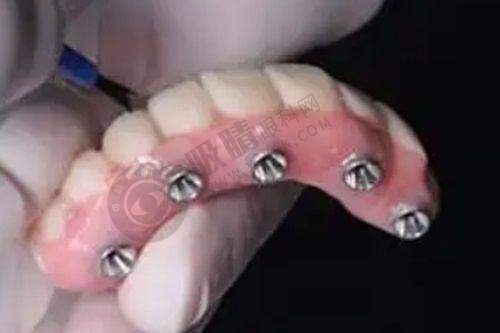 选择太原鼎植口腔医院，种牙为什么更放心？