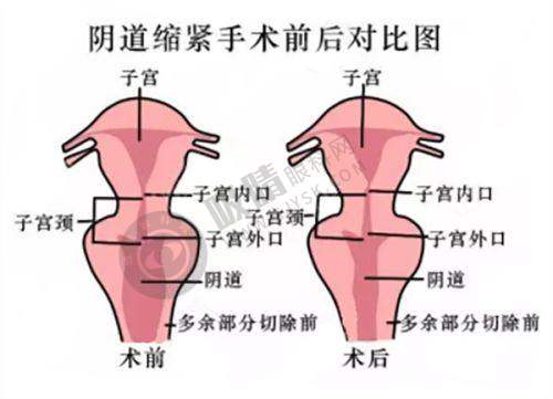 淄博美联臣整形医院正规吗?梅梁医生玻尿酸填充实例真实反馈