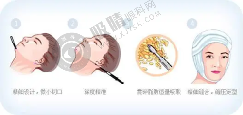 李喆眼周筋膜提升技术解析