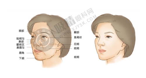 长沙艺星整形:数字化清奥,精细效率高的长沙取奥美定医院